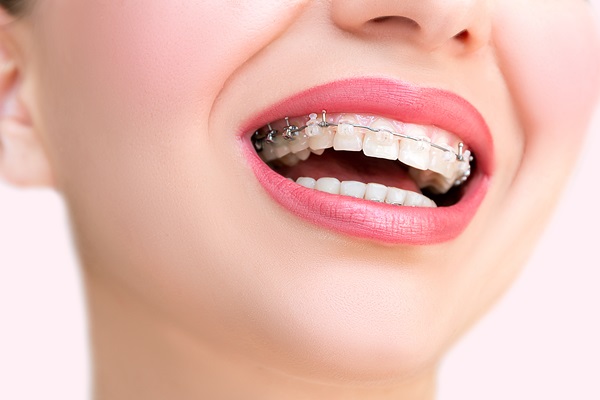 Benefits Of Clear Braces